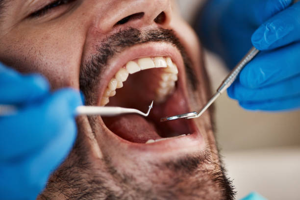 Best Emergency Root Canal Treatment in Coson, OK