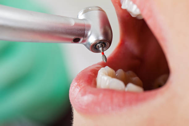 Best Emergency Root Canal Treatment in Coson, OK